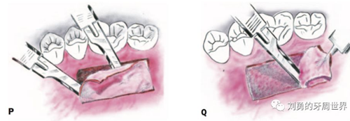 FGG游離牙齦移植在歷史上的各種改良以及發(fā)展前景 FGG游離牙齦移植在歷史上的各種改良以及發(fā)展前景