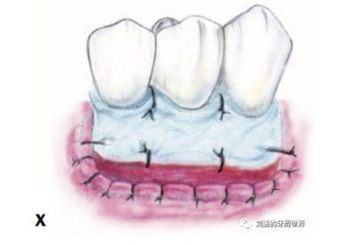 FGG游離牙齦移植在歷史上的各種改良以及發(fā)展前景 FGG游離牙齦移植在歷史上的各種改良以及發(fā)展前景