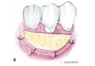 FGG游離牙齦移植在歷史上的各種改良以及發(fā)展前景 FGG游離牙齦移植在歷史上的各種改良以及發(fā)展前景