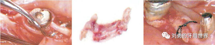 FGG游離牙齦移植在歷史上的各種改良以及發(fā)展前景 FGG游離牙齦移植在歷史上的各種改良以及發(fā)展前景