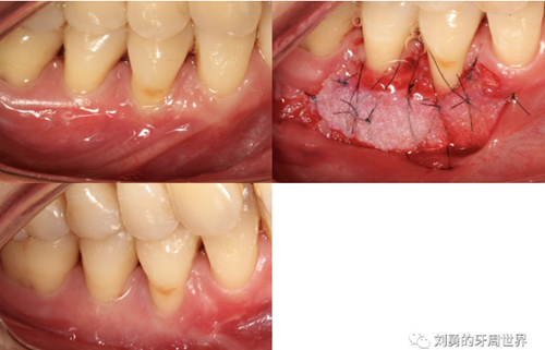 FGG游離牙齦移植在歷史上的各種改良以及發(fā)展前景 FGG游離牙齦移植在歷史上的各種改良以及發(fā)展前景