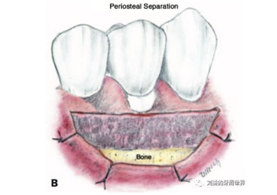 FGG游離牙齦移植在歷史上的各種改良以及發(fā)展前景 FGG游離牙齦移植在歷史上的各種改良以及發(fā)展前景
