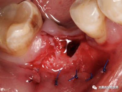 FGG游離牙齦移植在歷史上的各種改良以及發(fā)展前景 FGG游離牙齦移植在歷史上的各種改良以及發(fā)展前景