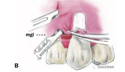 FGG游離牙齦移植在歷史上的各種改良以及發(fā)展前景 FGG游離牙齦移植在歷史上的各種改良以及發(fā)展前景