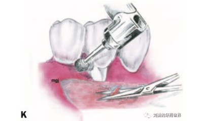 FGG游離牙齦移植在歷史上的各種改良以及發(fā)展前景 FGG游離牙齦移植在歷史上的各種改良以及發(fā)展前景