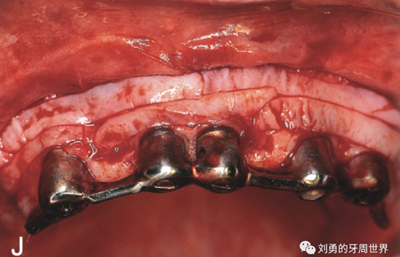 FGG游離牙齦移植在歷史上的各種改良以及發(fā)展前景 FGG游離牙齦移植在歷史上的各種改良以及發(fā)展前景