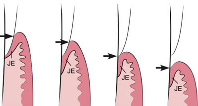 牙周解剖(一):角化齦和附著齦爭議總結(jié) 牙周解剖(一):角化齦和附著齦爭議總結(jié)