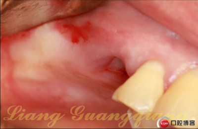 上頜竇外提升術(shù)中對(duì)大囊腫的處理 上頜竇外提升術(shù)中對(duì)大囊腫的處理