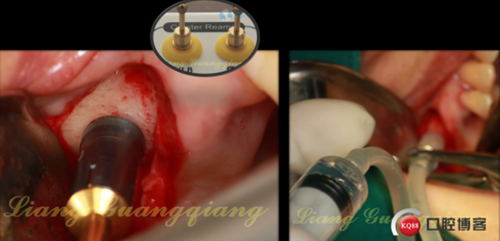 上頜竇外提升術(shù)中對(duì)大囊腫的處理 上頜竇外提升術(shù)中對(duì)大囊腫的處理