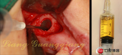 上頜竇外提升術(shù)中對(duì)大囊腫的處理 上頜竇外提升術(shù)中對(duì)大囊腫的處理