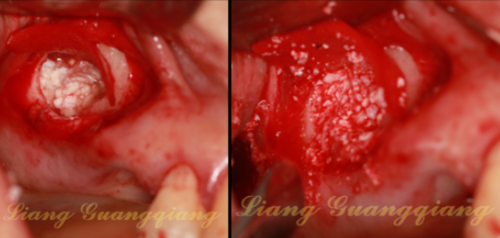 上頜竇外提升術(shù)中對(duì)大囊腫的處理 上頜竇外提升術(shù)中對(duì)大囊腫的處理