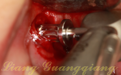 上頜竇外提升術(shù)中對(duì)大囊腫的處理 上頜竇外提升術(shù)中對(duì)大囊腫的處理