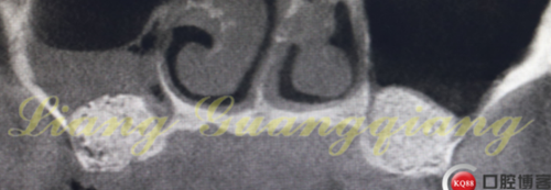 上頜竇外提升術(shù)中對(duì)大囊腫的處理 上頜竇外提升術(shù)中對(duì)大囊腫的處理