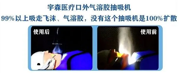宇森口外氣溶膠抽吸機(jī) 宇森口外氣溶膠抽吸機(jī)