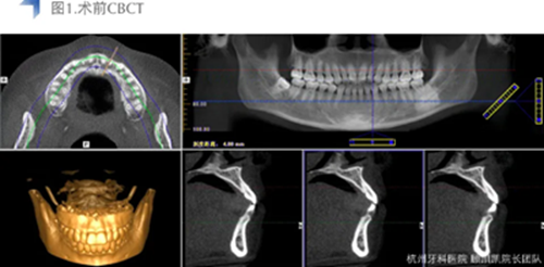 Vitique瓷貼面粘接系統(tǒng)的臨床應(yīng)用