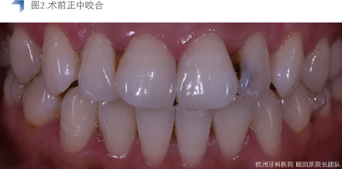 Vitique瓷貼面粘接系統(tǒng)的臨床應(yīng)用