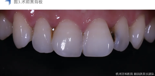 Vitique瓷貼面粘接系統(tǒng)的臨床應(yīng)用