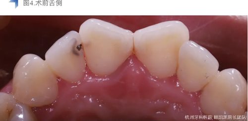 Vitique瓷貼面粘接系統(tǒng)的臨床應(yīng)用