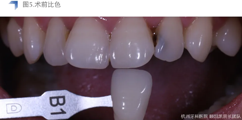 Vitique瓷貼面粘接系統(tǒng)的臨床應(yīng)用