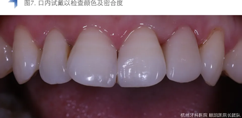 Vitique瓷貼面粘接系統(tǒng)的臨床應(yīng)用