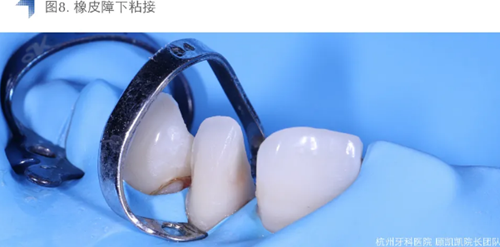 Vitique瓷貼面粘接系統(tǒng)的臨床應(yīng)用