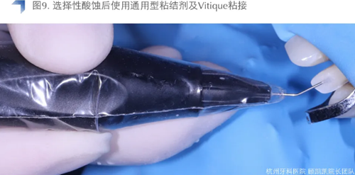 Vitique瓷貼面粘接系統(tǒng)的臨床應(yīng)用