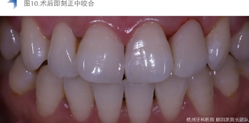 Vitique瓷貼面粘接系統(tǒng)的臨床應(yīng)用