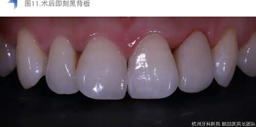 Vitique瓷貼面粘接系統(tǒng)的臨床應(yīng)用