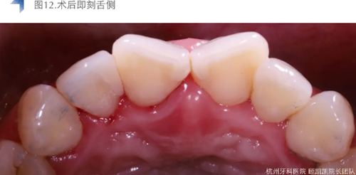 Vitique瓷貼面粘接系統(tǒng)的臨床應(yīng)用