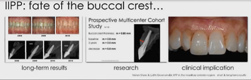 即刻種植的成功要素 即刻種植的成功要素