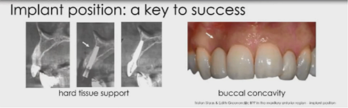 即刻種植的成功要素 即刻種植的成功要素