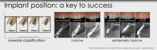 即刻種植的成功要素 即刻種植的成功要素