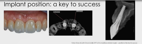 即刻種植的成功要素 即刻種植的成功要素