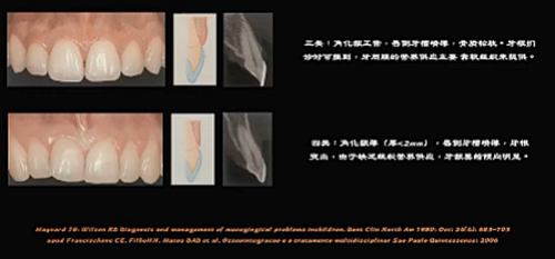 即刻種植的成功要素 即刻種植的成功要素