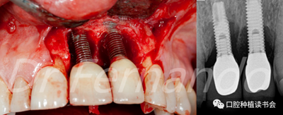 種植體周圍炎的軟硬組織重建治療(上) 種植體周圍炎的軟硬組織重建治療(上)