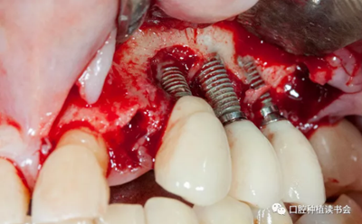 種植體周圍炎的軟硬組織重建治療(下) 種植體周圍炎的軟硬組織重建治療(下)