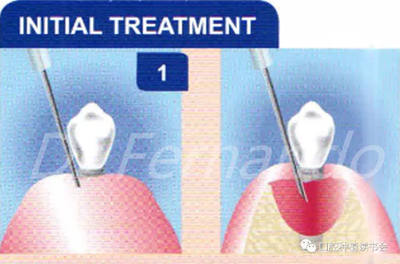 種植體周圍炎的軟硬組織重建治療(下) 種植體周圍炎的軟硬組織重建治療(下)