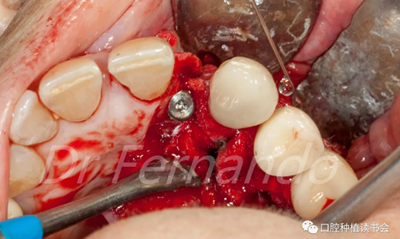 種植體周圍炎的軟硬組織重建治療(下) 種植體周圍炎的軟硬組織重建治療(下)