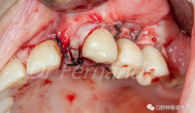 種植體周圍炎的軟硬組織重建治療(下) 種植體周圍炎的軟硬組織重建治療(下)