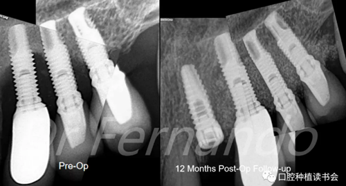 種植體周圍炎的軟硬組織重建治療(下) 種植體周圍炎的軟硬組織重建治療(下)