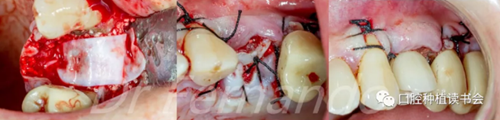 種植體周圍炎的軟硬組織重建治療(下) 種植體周圍炎的軟硬組織重建治療(下)