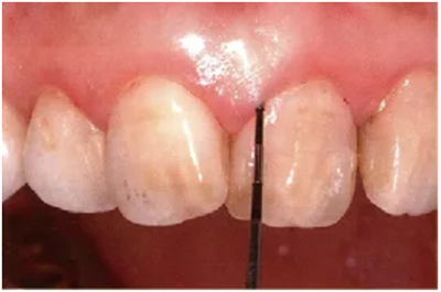 牙周袋深度測定法 牙周袋深度測定法