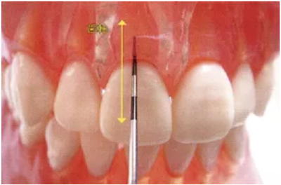 牙周袋深度測定法 牙周袋深度測定法