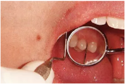 牙周袋深度測定法 牙周袋深度測定法