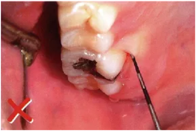 牙周袋深度測定法 牙周袋深度測定法