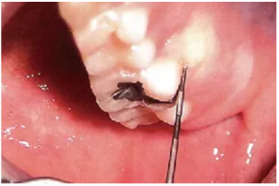 牙周袋深度測定法 牙周袋深度測定法