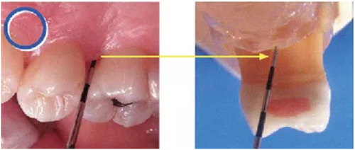 牙周袋深度測定法 牙周袋深度測定法