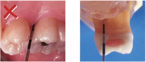 牙周袋深度測定法 牙周袋深度測定法