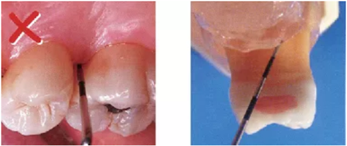 牙周袋深度測定法 牙周袋深度測定法