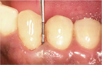 牙周袋深度測定法 牙周袋深度測定法